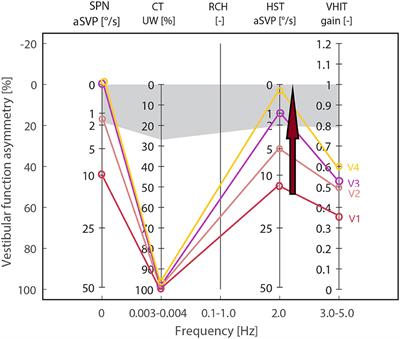 Head-shaking-induced nystagmus reflects dynamic vestibular compensation: A 2-year follow-up study